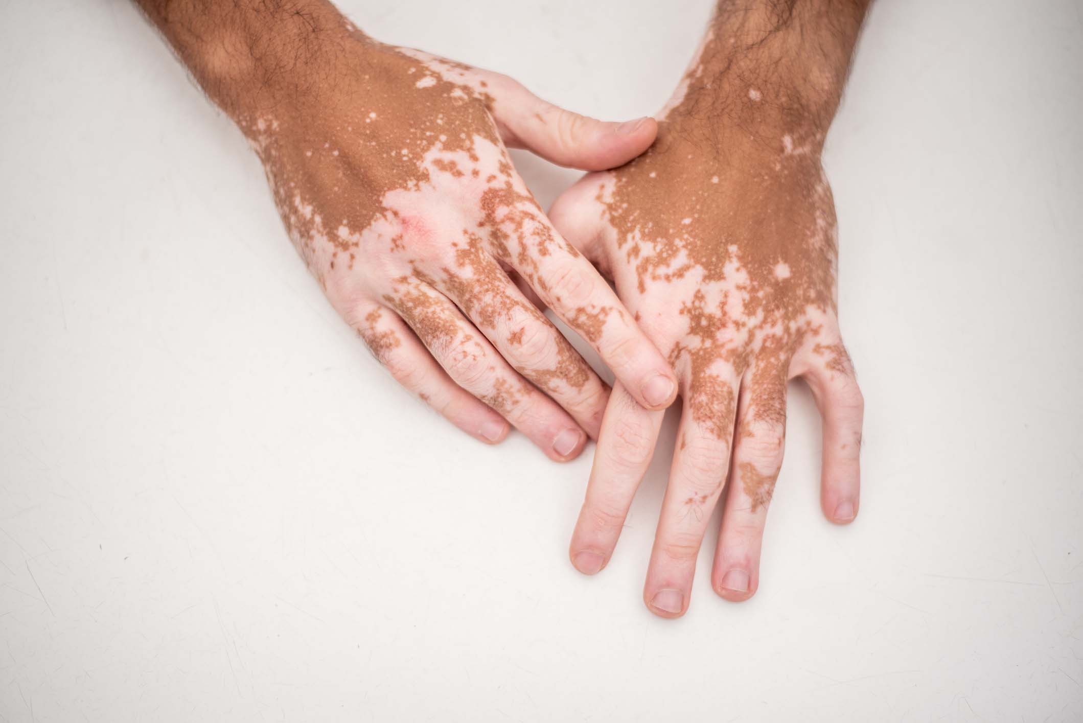 Vitiligo Treatment in Monroe, LA and Southlake, TX