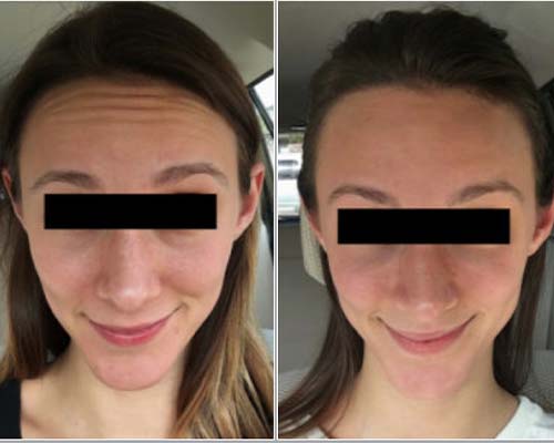 Botox Before and After Pictures Monroe, LA and Southlake, TX