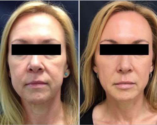 Liquid Facelift Before and After Pictures Monroe, LA and Southlake, TX