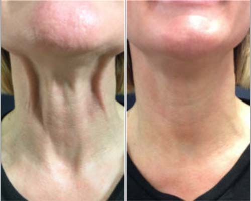 NeckLift Before and After Pictures Monroe, LA and Southlake, TX
