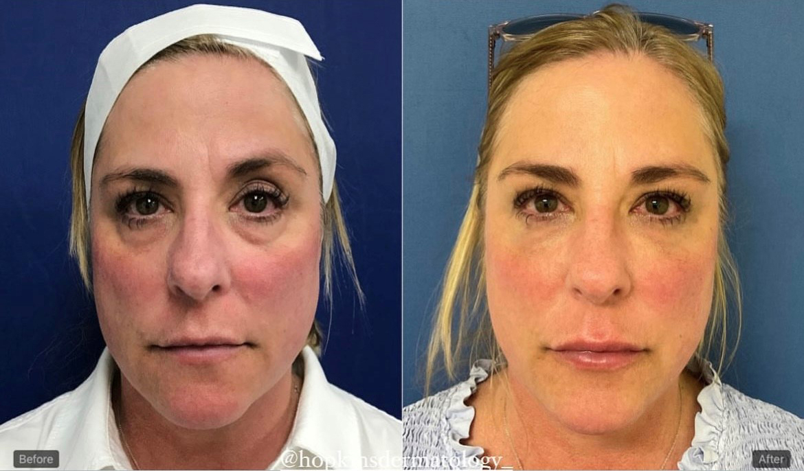 Dermal Fillers and Injectables Before and After Pictures Monroe, LA and Southlake, TX
