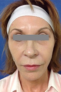 Eyelid Rejuvenation Before and After Pictures Monroe, LA and Southlake, TX