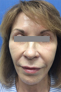 Eyelid Rejuvenation Before and After Pictures Monroe, LA and Southlake, TX