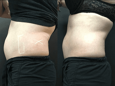 Fotona Laser Before and After Pictures Monroe, LA and Southlake, TX