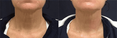 Fotona Laser Before and After Pictures Monroe, LA and Southlake, TX