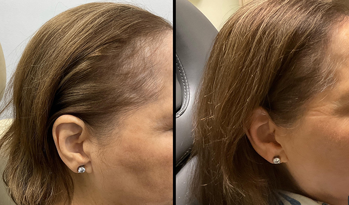 hair loss treatment 2 Hair Loss Treatment Before and After Pictures Monroe, LA and Southlake, TX