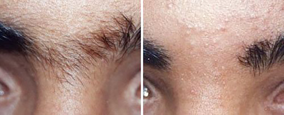laser hair removal b and a Laser Hair Removal in Monroe, LA and Southlake, TX