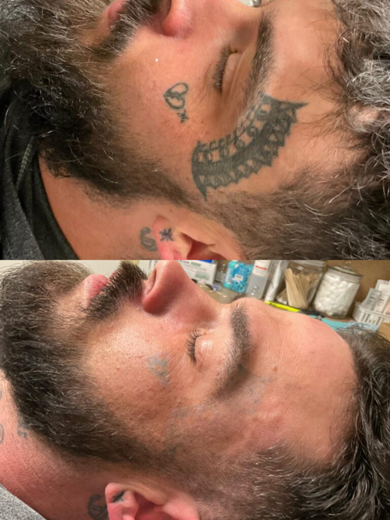 Tattoo Removal in Monroe, LA and Southlake, TX
