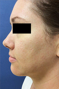 Microlaser and PRP Before and After Pictures Monroe, LA and Southlake, TX