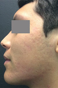 Microlaser and PRP Before and After Pictures Monroe, LA and Southlake, TX