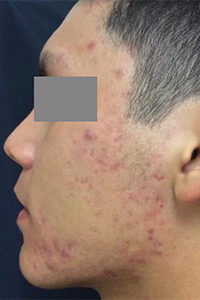 Microlaser and PRP Before and After Pictures Monroe, LA and Southlake, TX