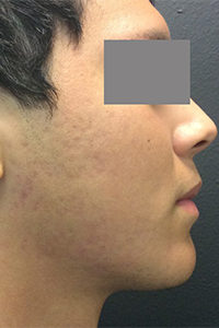 Microlaser and PRP Before and After Pictures Monroe, LA and Southlake, TX