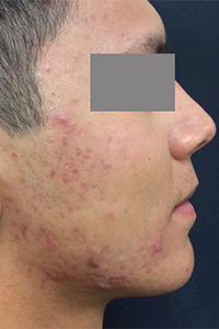 Microlaser and PRP Before and After Pictures Monroe, LA and Southlake, TX
