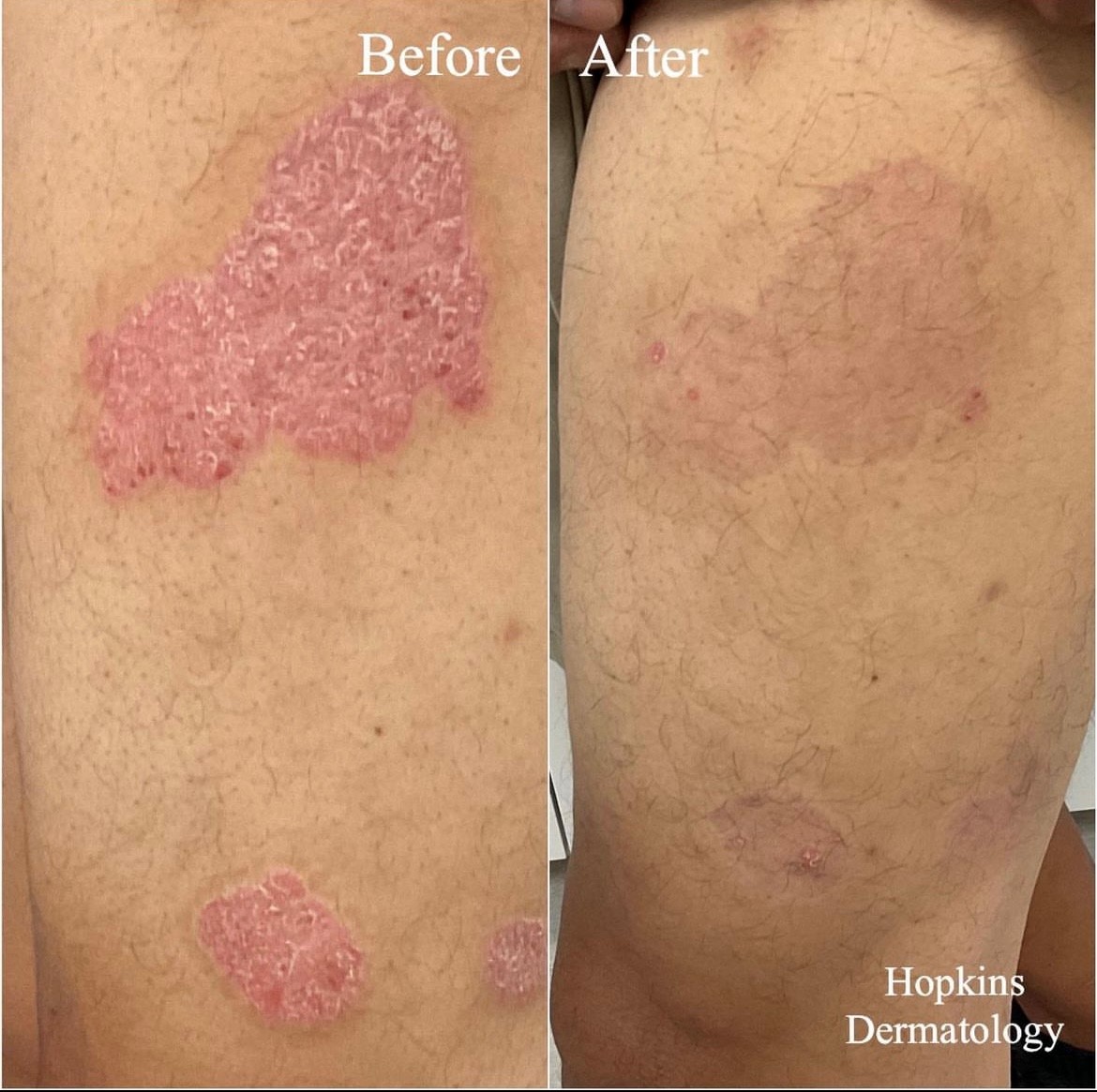 Rash Treatment in Monroe, LA and Southlake, TX