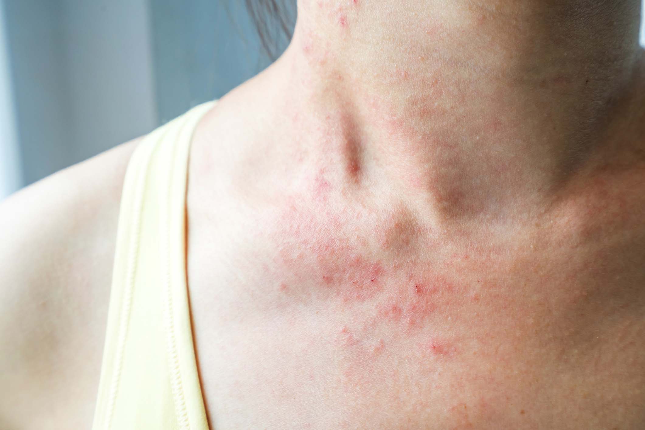 Rash Treatment in Monroe, LA and Southlake, TX