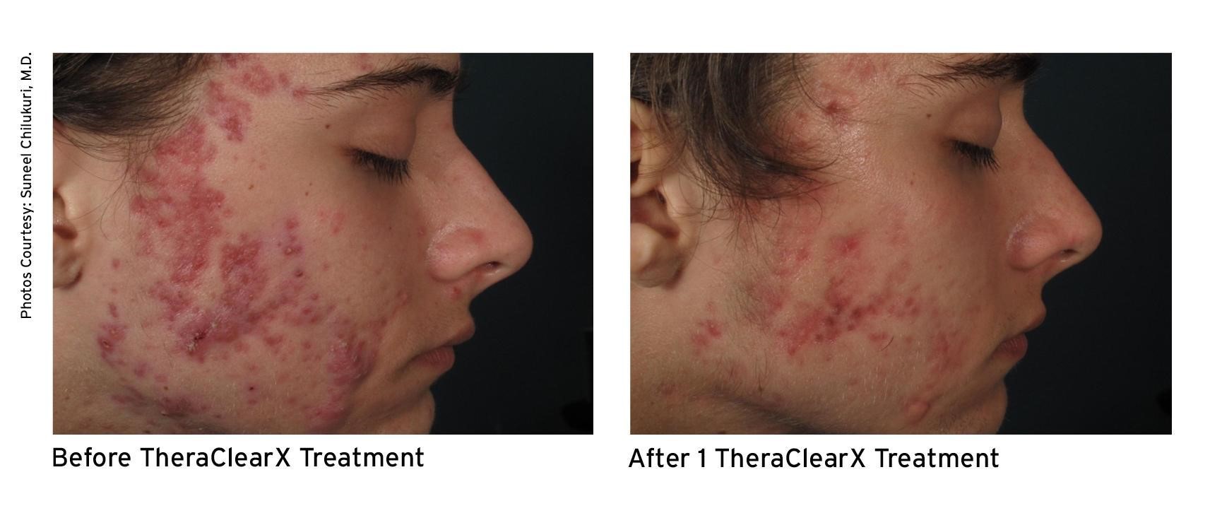 theraclearx2