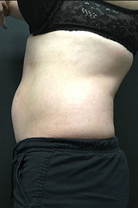 TruSculpt® Before and After Pictures Monroe, LA and Southlake, TX