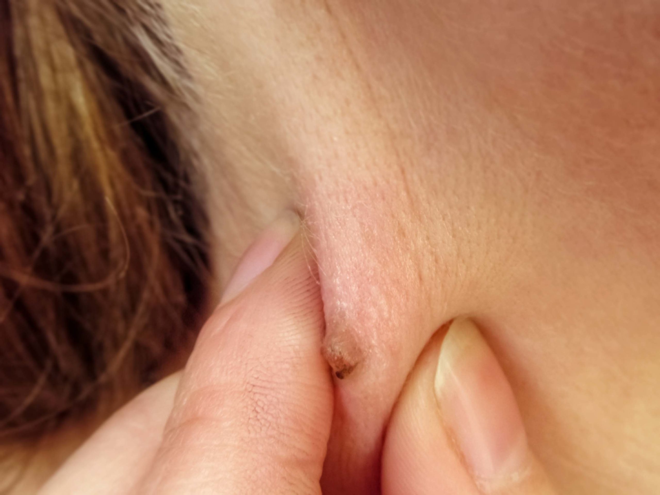 Wart Removal Monroe, LA | Southlake, TX Wart Removal Wart Removal Monroe, LA | Southlake, TX Wart Removal